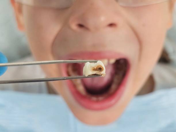Best Broken or Chipped Tooth Repair in University Park, NM